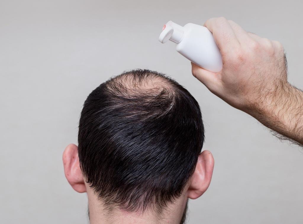 Breaking the stigma of male hair loss  15 Minutes by Cornerstone