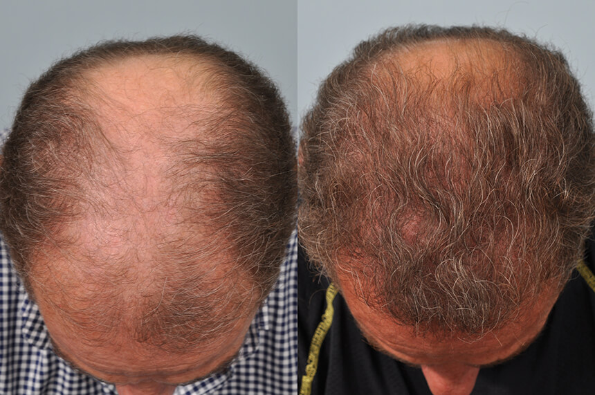 Sam Khalaf hair transplant one year later - crown