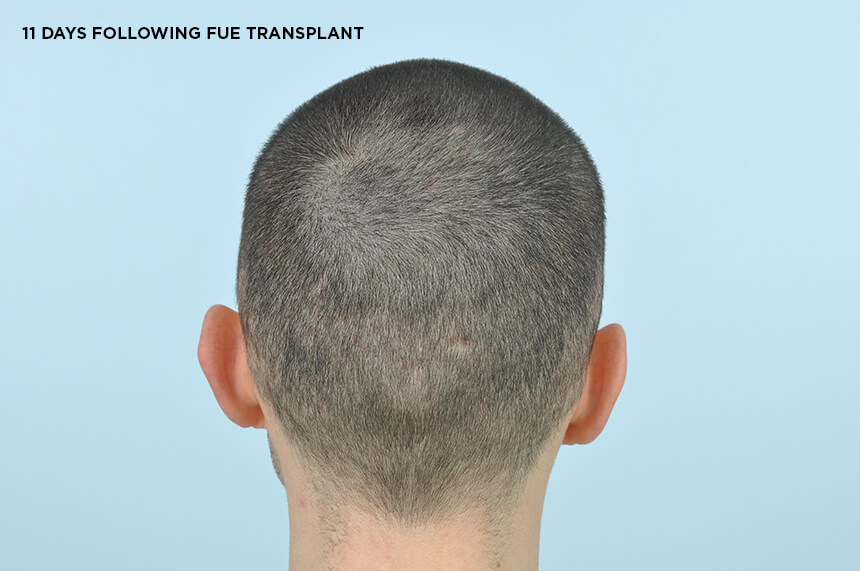Donor Scars – FUE - Hair Transplant Clinic Ireland