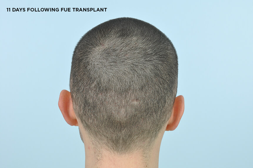 Donor Scars – FUE - Hair Transplant Clinic Ireland Donor Scars – FUE - Hair Transplant Clinic Ireland