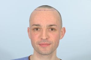 James Kavanagh Hair Transplant at HRBR