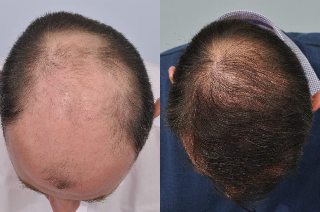 Bald scalp hair transplant before and after photos
