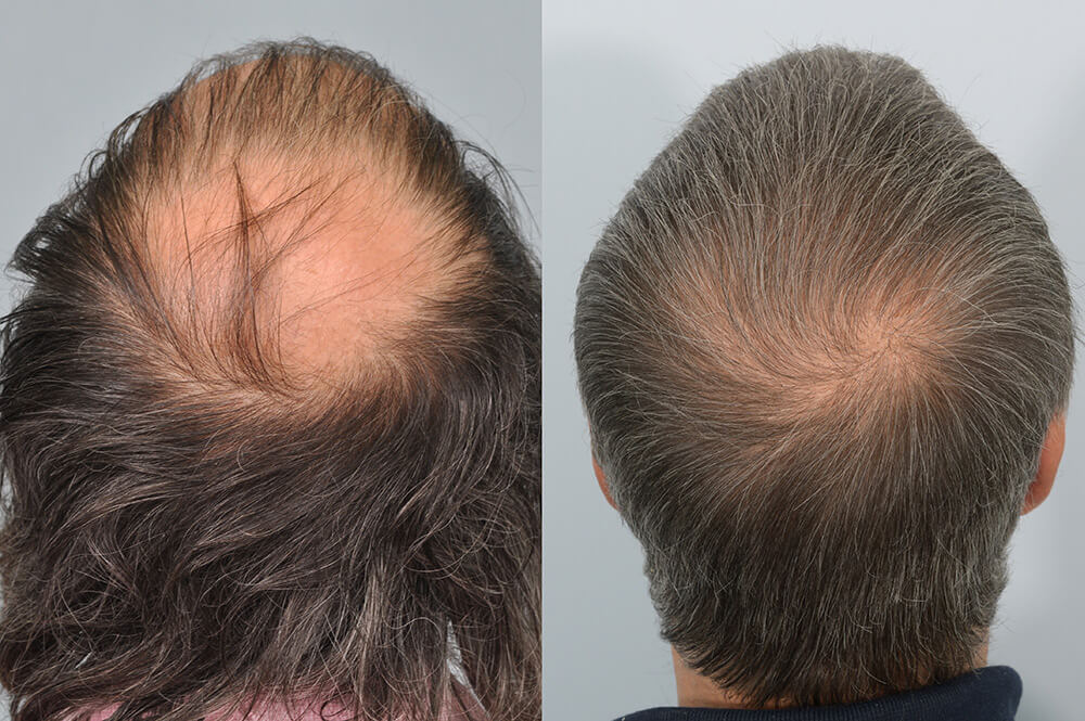 finasteride before and after crown