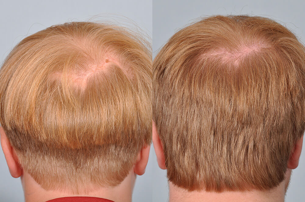 Treatment of Scars with Hair Transplantation | HRBR