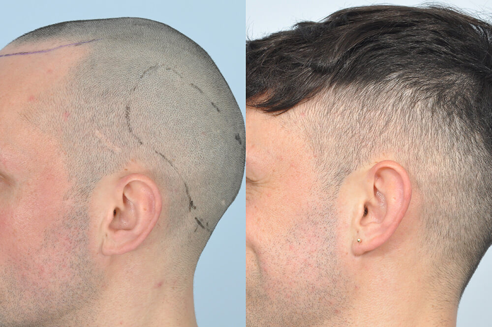Treatment of Scars with Hair Transplantation | HRBR Treatment of Scars with Hair Transplantation | HRBR