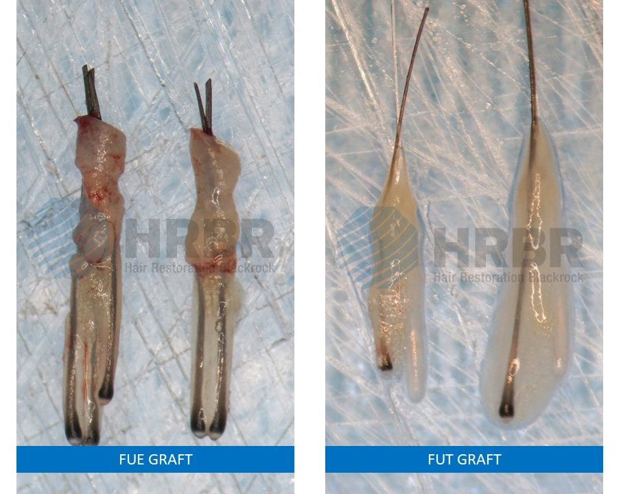 FUE graft Vs FUT graft image