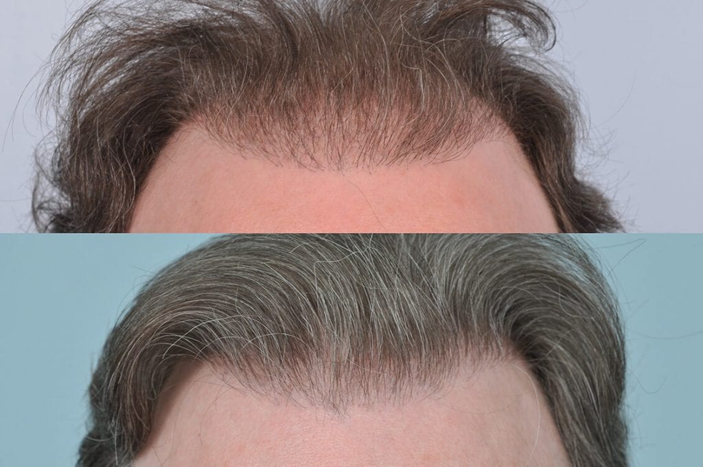 Case Study One - Repaired Hair Line