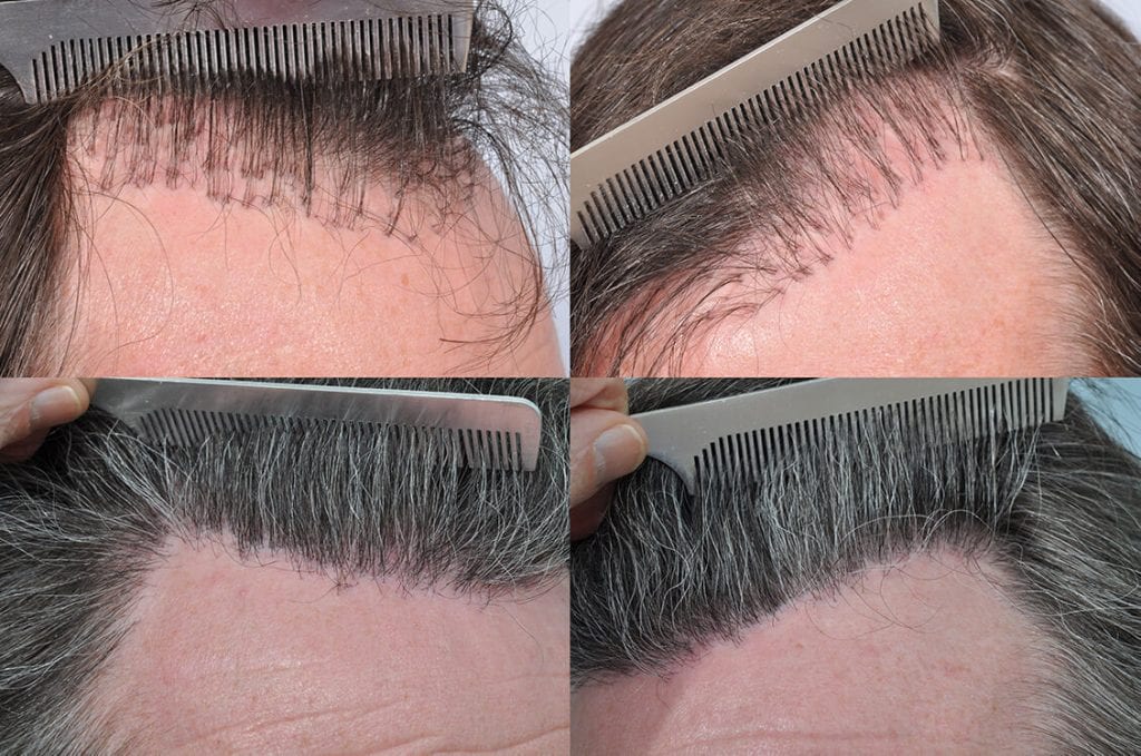 How much does a hair transplant of 1,000 grafts cost in Turkey? - Quora