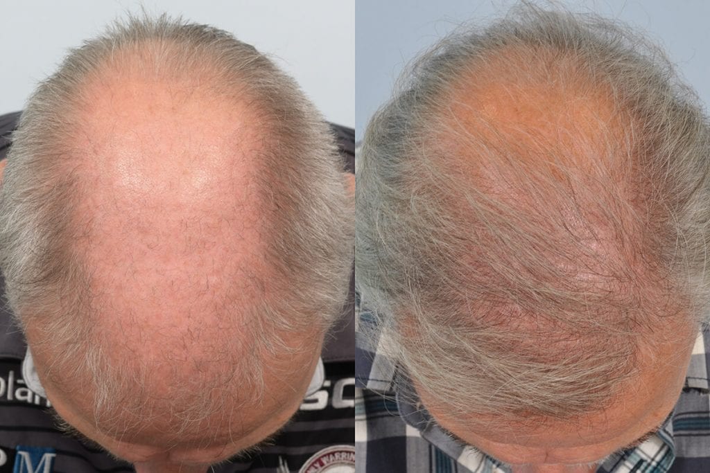 Bald scalp hair transplant before and after photos