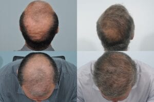Before and after - 10 years post hair transplant