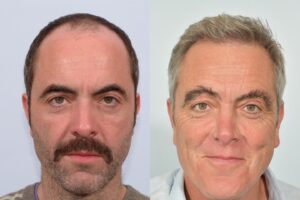 James Nesbitt before and after Sept 2021