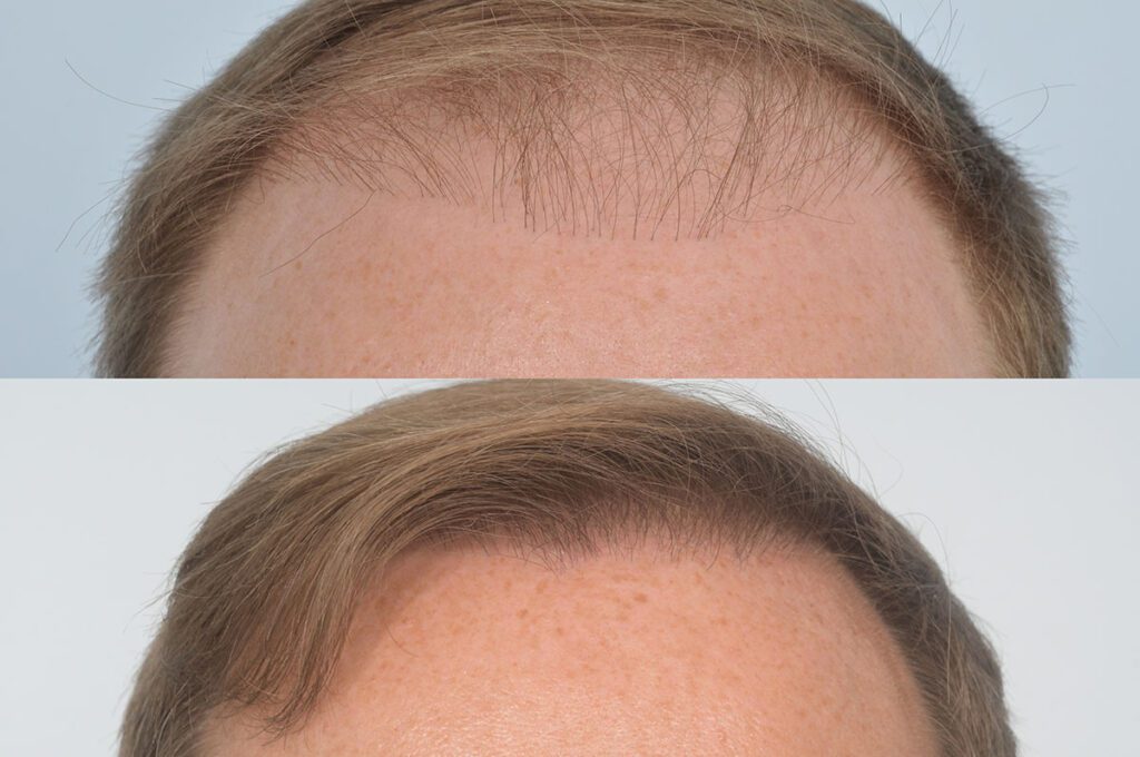 Case Study Four - Repaired Hairline