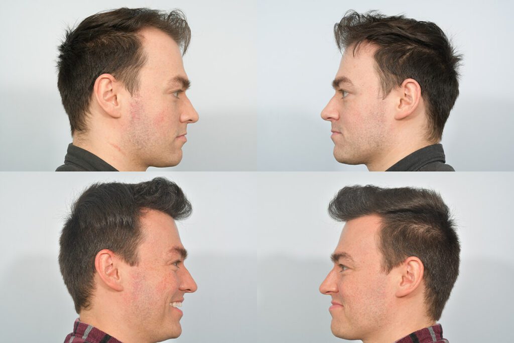 Hairline Lowering: Surgery or Hair Transplant | All you need to know