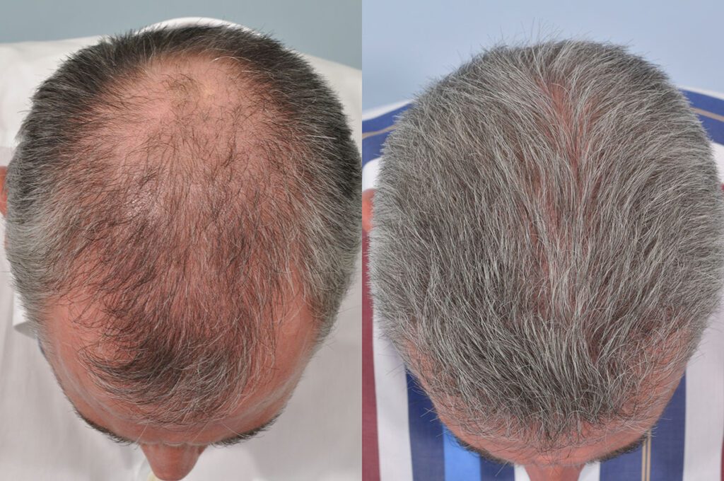 Hair Transplants – Before and After - Hair Transplant Clinic Ireland