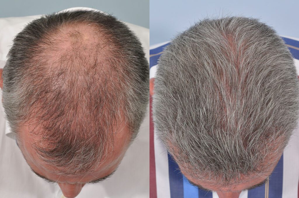 Body Hair Transplant Before and After Photos  Foundation For Hair  Restoration