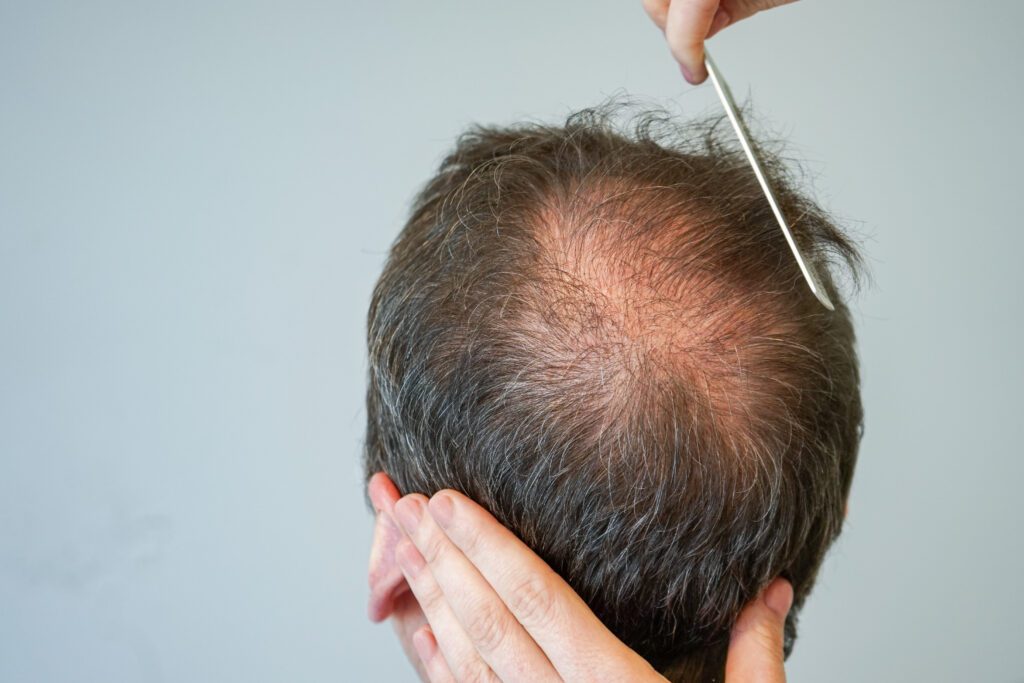 Androgenetic alopecia MedlinePlus Genetics