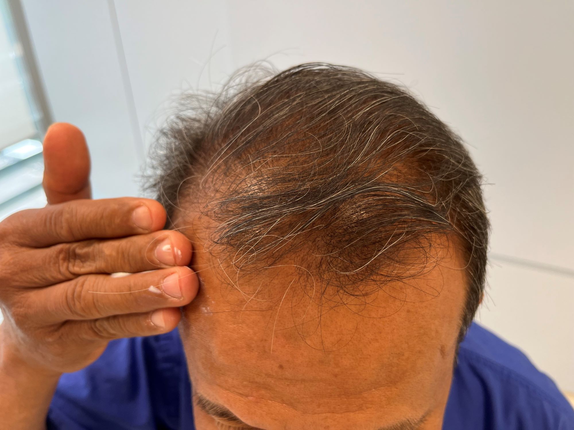 Breakthrough in cancer hair loss treatment discovered   healthcareineuropecom