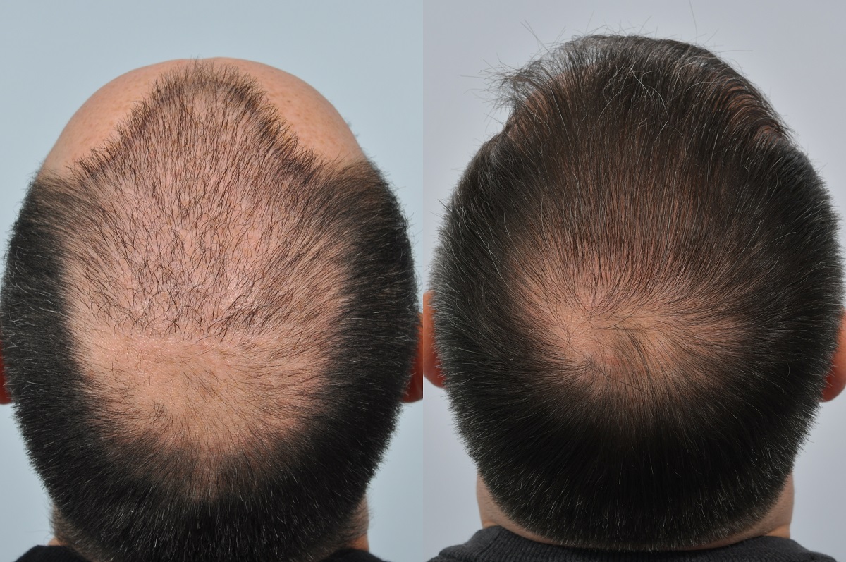hair transplant repair - poorly designed hair line
