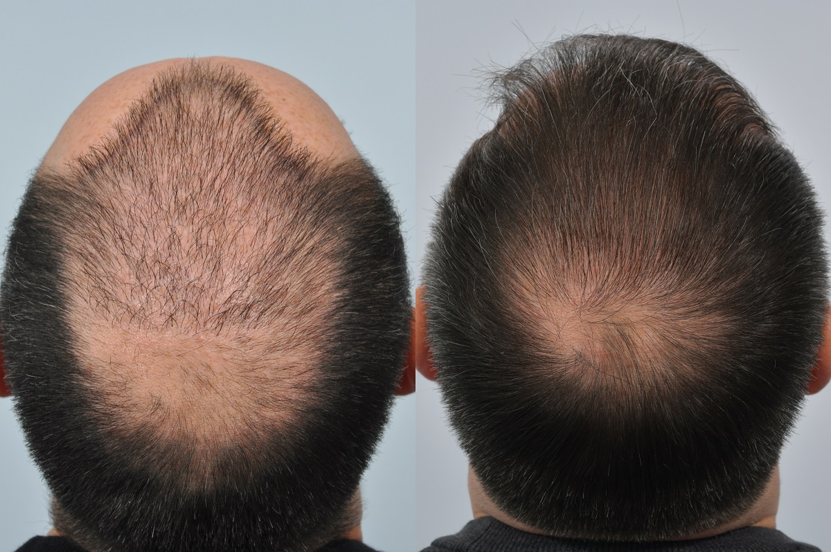 Uncategorized Archives  Page 2 of 4  Nuleaf Hair Transplant Centre Pune