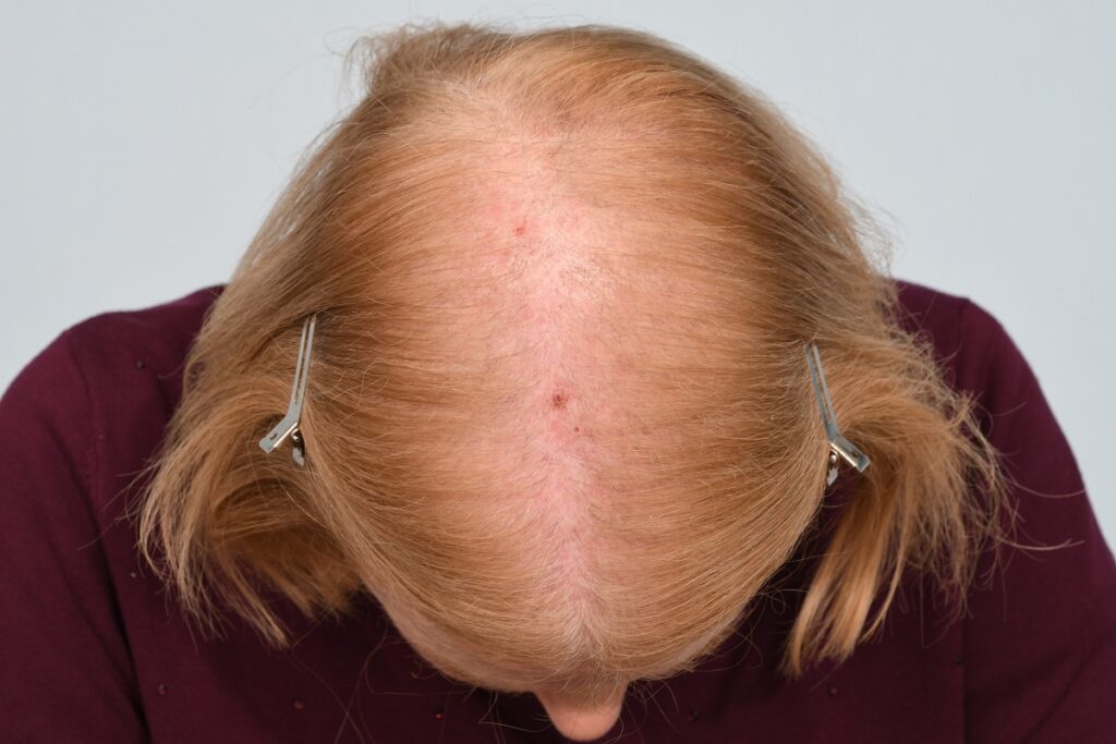 Female pattern hair loss before treatment