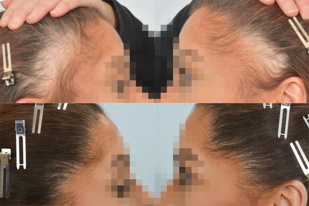 Traction alopecia - before and after transplant