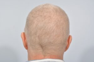 FUT scar after hair transplant