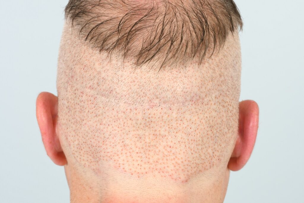 FUE patient immediately after surgery