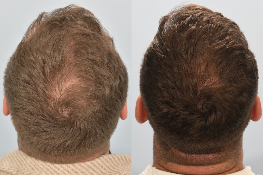 Tadhg Beirne hair transplant (updated)
