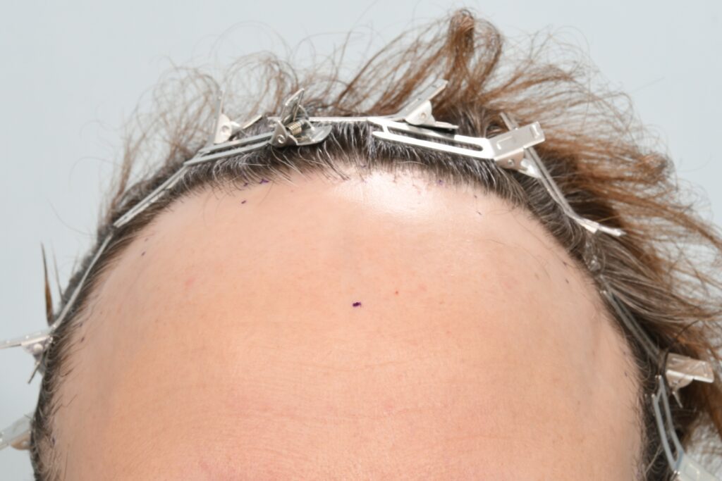 scarring alopecia - front view