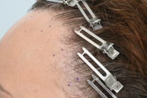 scarring alopecia