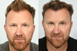 Jason Byrne hair transplant at HRBR. 6 month post-op before and after.