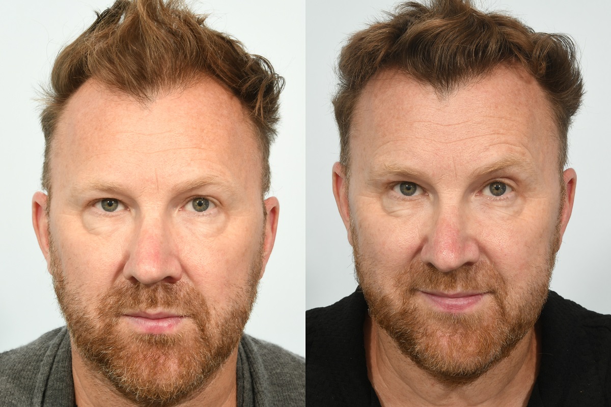 Jason Byrne hair transplant at HRBR. 6 month post-op before and after.