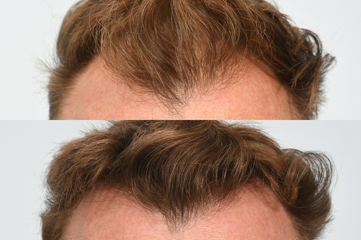 Jason Byrne hair transplant at HRBR. 6 month post-op before and after - hairline