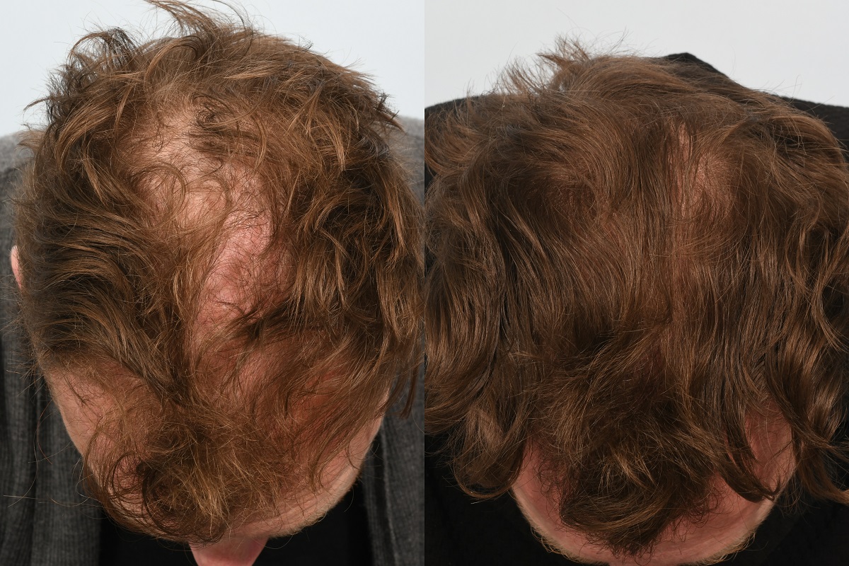 Jason Byrne hair transplant at HRBR. 6 month post-op before and after - crown.