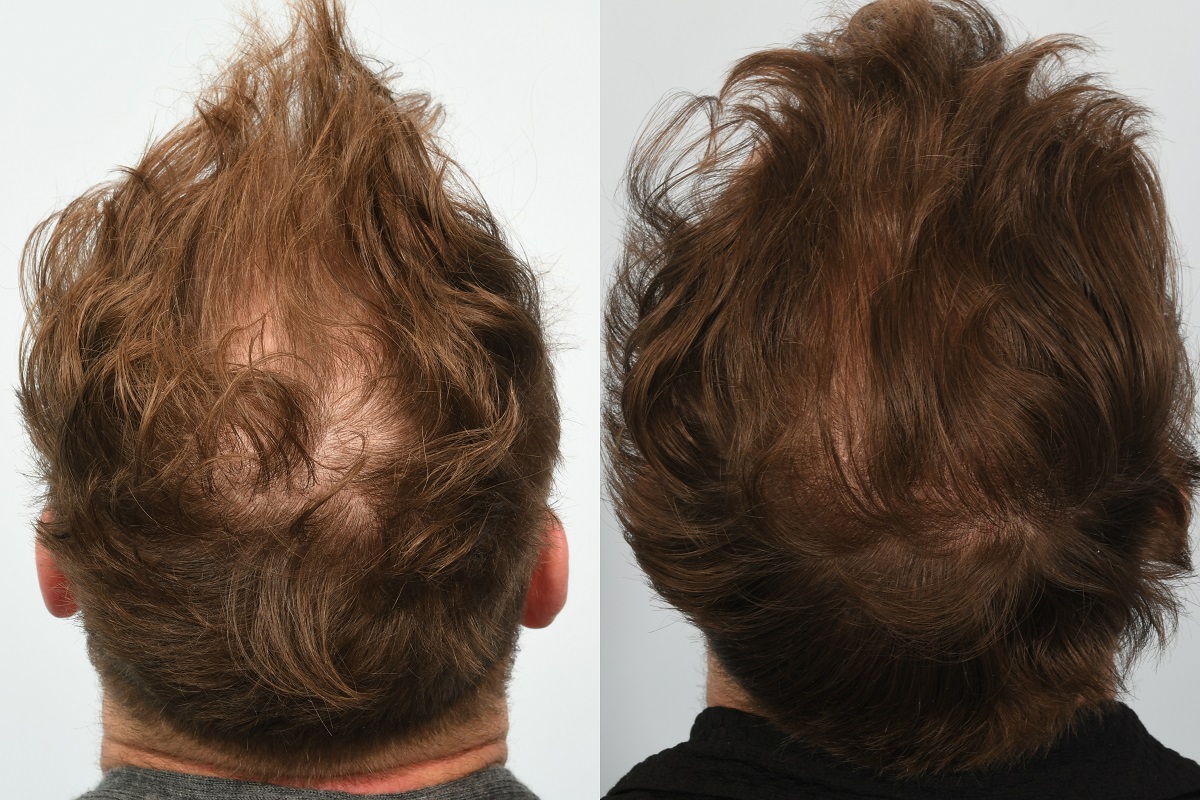 Jason Byrne hair transplant at HRBR. 6 month post-op before and after -crown reverse angle.