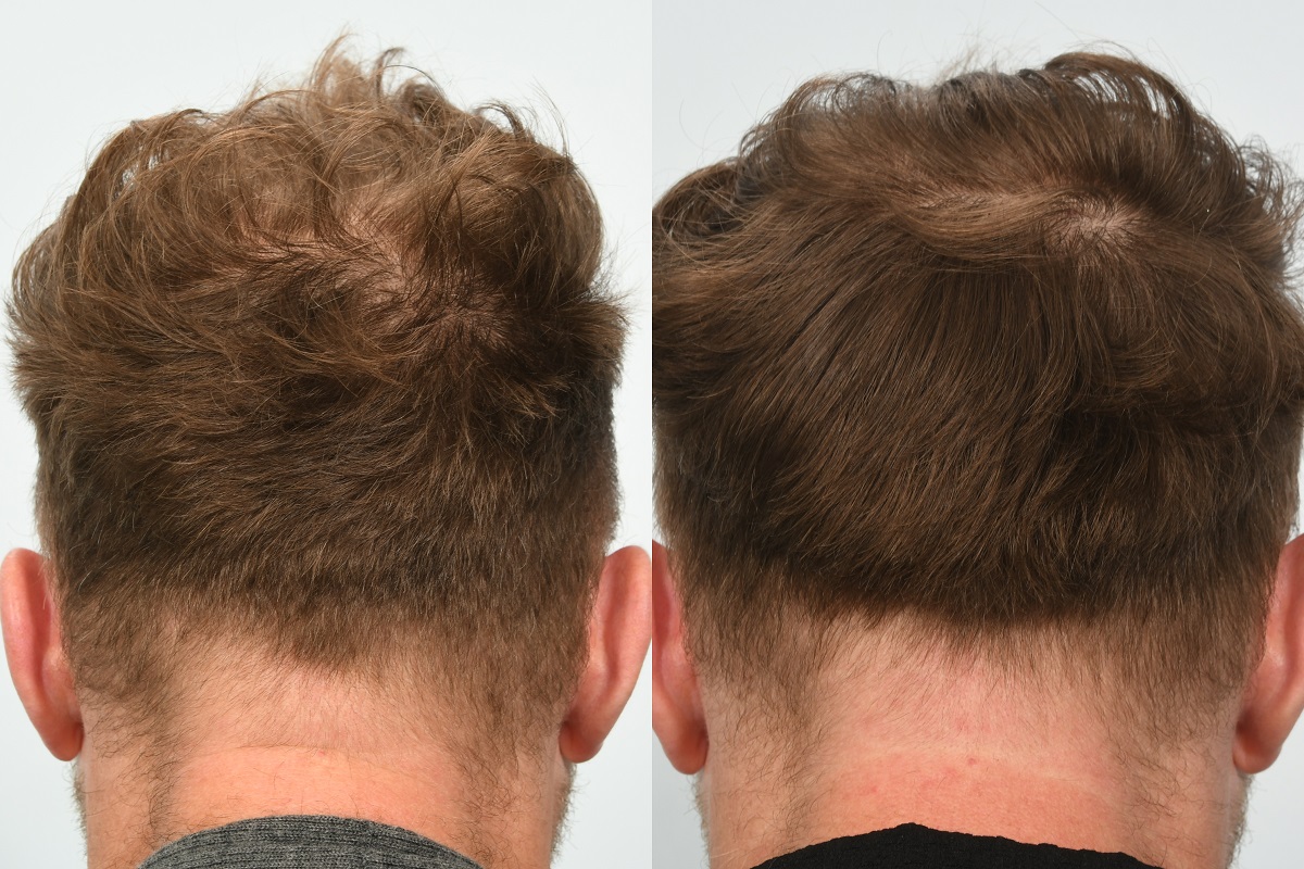 Jason Byrne hair transplant at HRBR. 6 month post-op before and after - back of head.