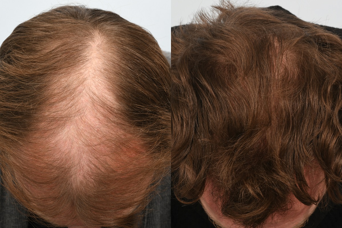 Jason Byrne hair transplant at HRBR. 6 month post-op before and after - top of head.