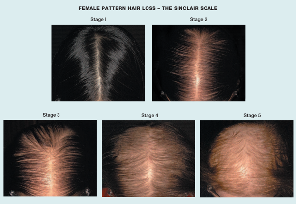 sincalir scale of female pattern hair loss